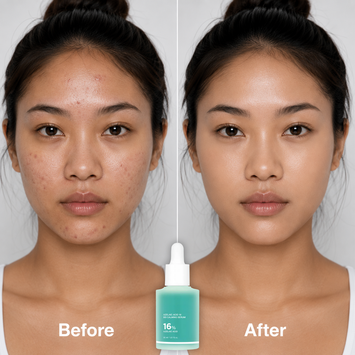 16% Azelaic Acid Calming Serum with Niacinamide and Vitamin B5