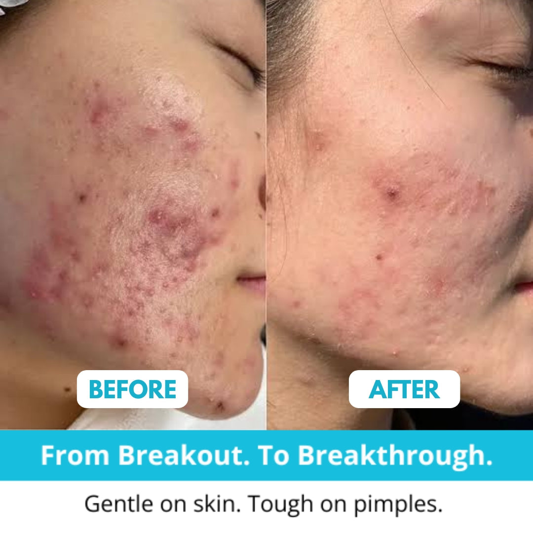 Cuttable Hydrocolloid Acne Patch Roll for Pimples & Skin Care