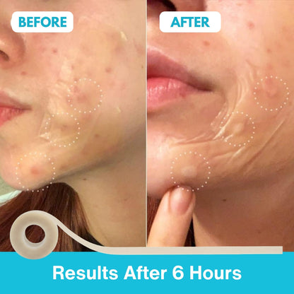 Cuttable Hydrocolloid Acne Patch Roll for Pimples & Skin Care